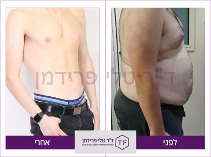 טיפול וייזר וגניקומסטיה בחזה לפני ואחרי - ד"ר טלי פרידמן