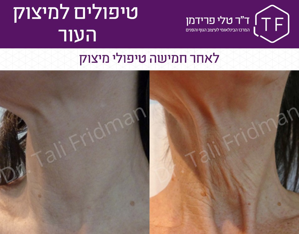תמונות לפני ואחרי טיפול למיצוק העור בצוואר