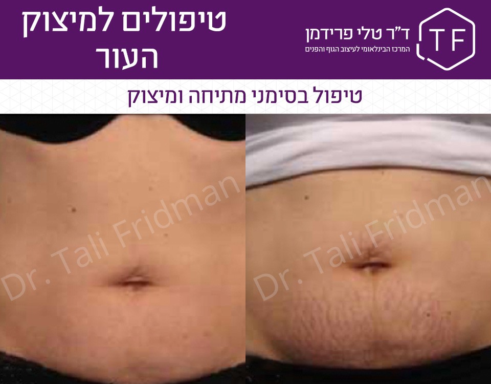 תמונות לפני ואחרי טיפול למיצוק העור בבטן 