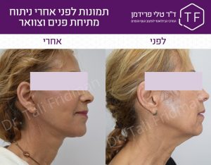 תמונות לפני ואחרי ניתוח מתיחת פנים וצוואר - ד"ר טלי פרידמן