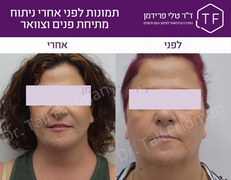 תמונות לפני ואחרי ניתוח מתיחת פנים וצוואר - ד