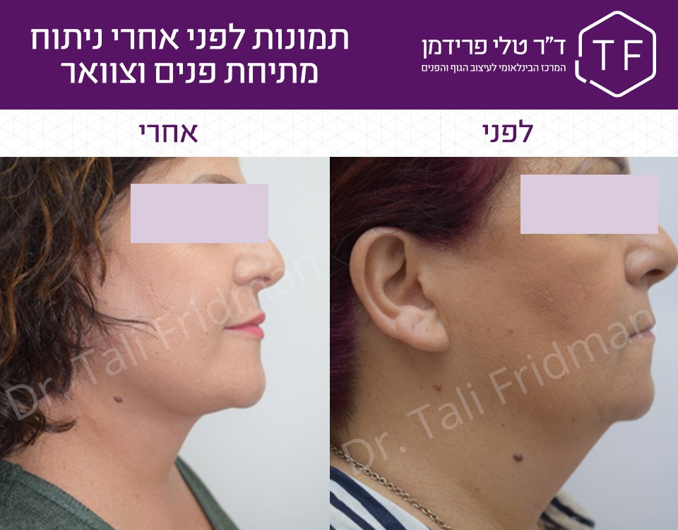 תמונות לפני ואחרי ניתוח מתיחת פנים וצוואר - ד