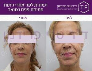 תמונות לפני ואחרי ניתוח מתיחת פנים וצוואר - ד"ר טלי פרידמן