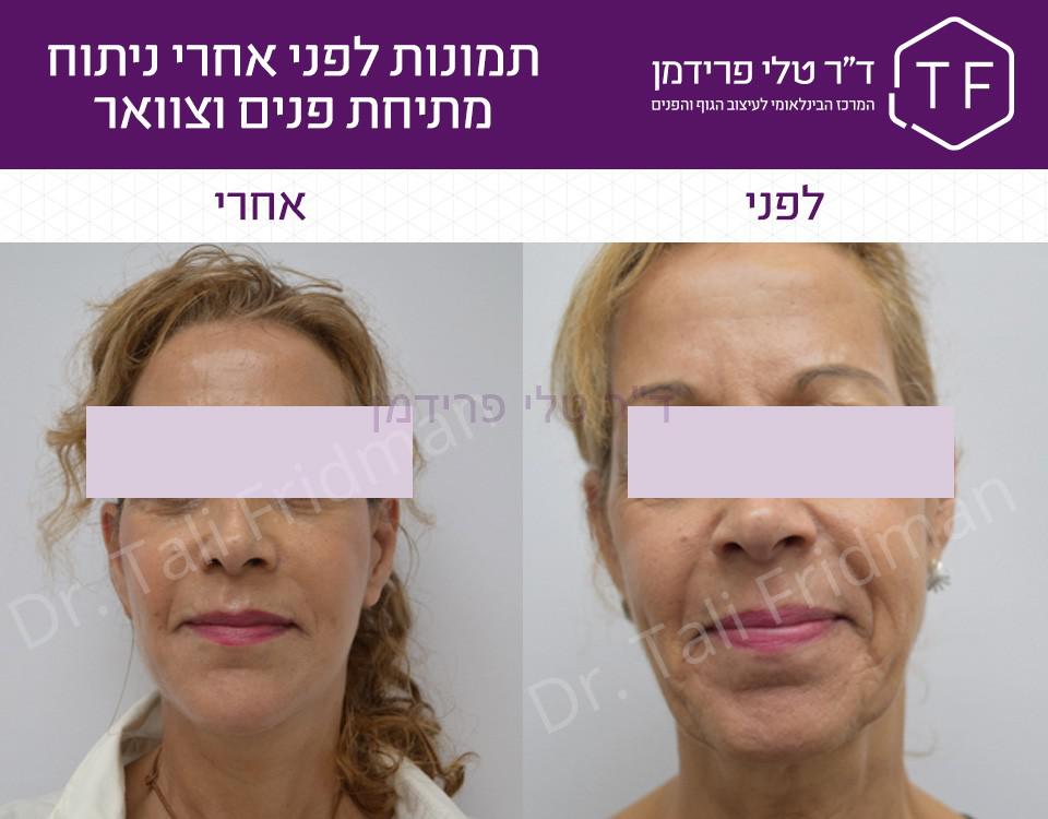 תמונות לפני ואחרי ניתוח מתיחת פנים וצוואר - ד"ר טלי פרידמן