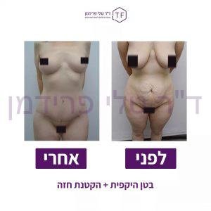 ניתוח הקטנת חזה