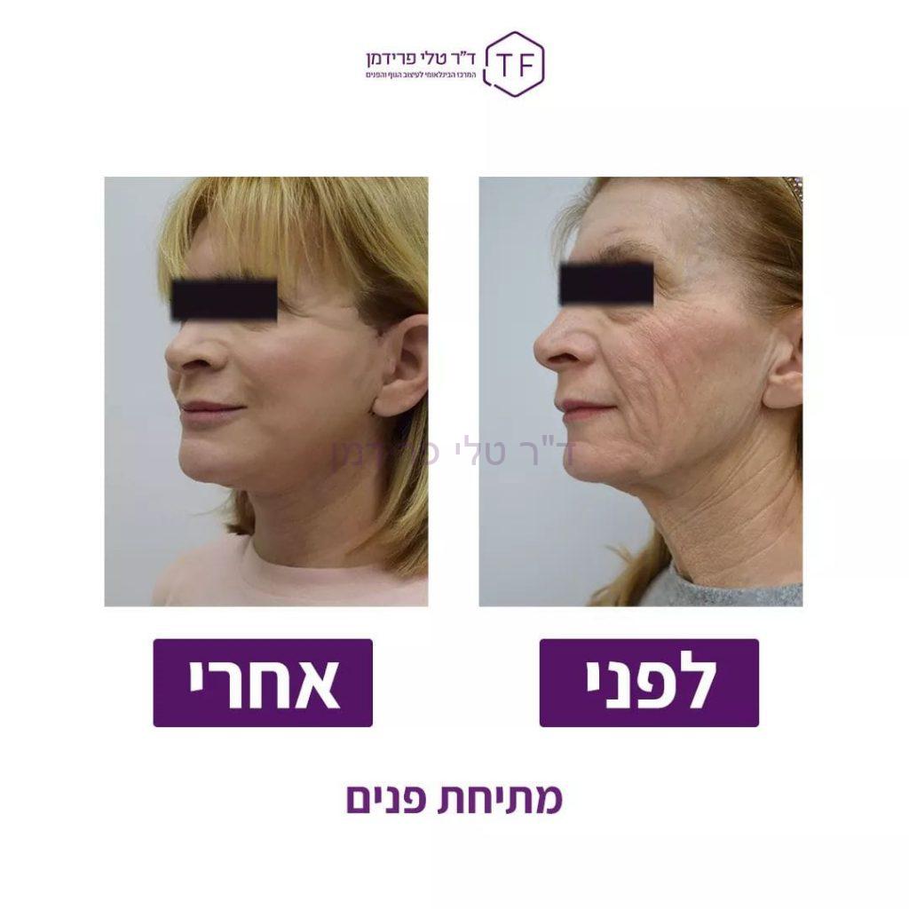 מתיחת פנים לפני ואחרי - ד"ר טלי פרידמן