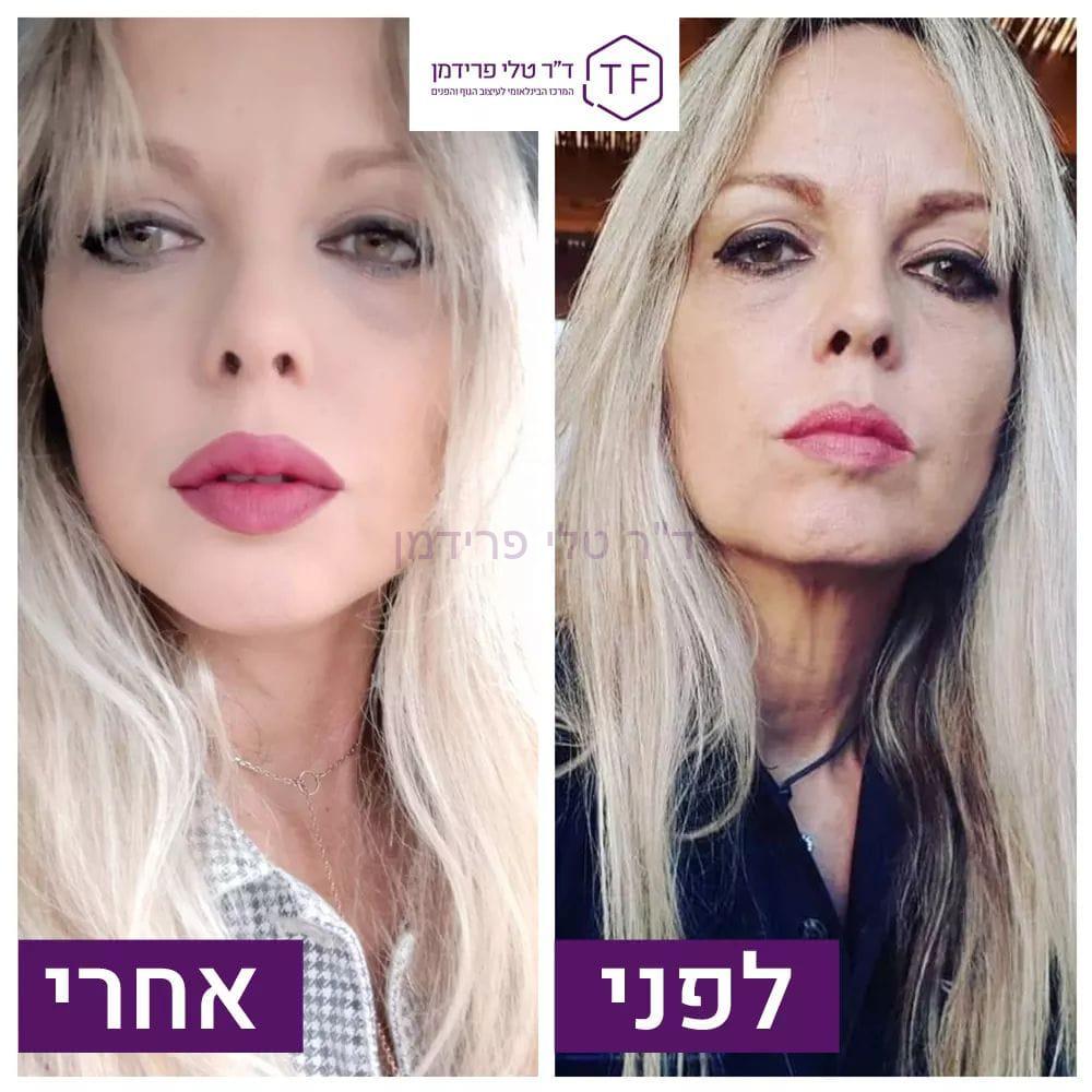 מתיחת פנים לפני ואחרי - ד"ר טלי פרידמן