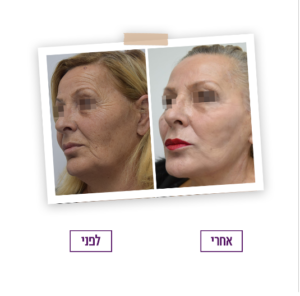 לפני ואחרי - ניתוח פנים