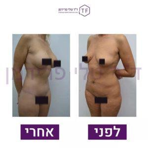לפני ואחרי ניתוח הגדלת חזה