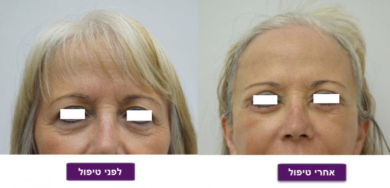 ניתוחי פנים לפני ואחרי - ד"ר טלי פרידמן