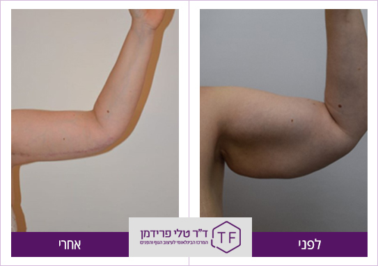 עיצוב זרועות לפני ואחרי - ד"ר טלי פרידמן