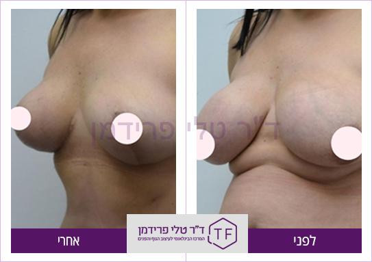 הקטנת חזה לפני ואחרי - ד"ר טלי פרידמן