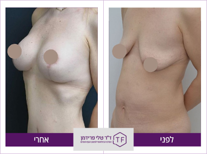הגדלת חזה ועיצוב פלג גוף עליון לפני ואחרי - ד"ר טלי פרידמן