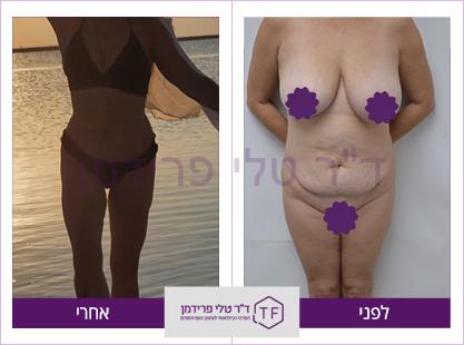 עיצוב פלג גוף עליון ותחתון מלא לפני ואחרי - ד"ר טלי פרידמן