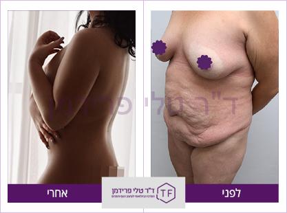 עיצוב פלג גוף עליון, פלג גוף תחתון והרמת חזה לפניו אחרי - ד"ר טלי פרידמן