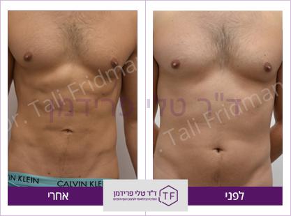 וייזר