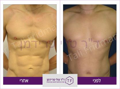 וייזר