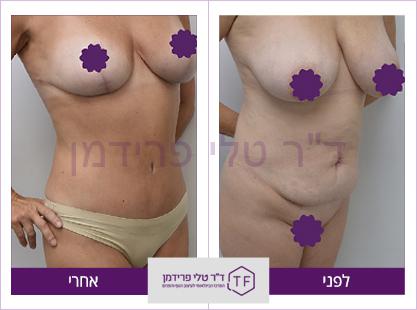 מאמי מייקאובר, מתיחה היקפית והרמת חזה לפני ואחרי - ד"ר טלי פרידמן