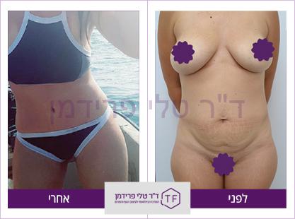 מאמי מייקאובר, ומתיחה היקפית לפני ואחרי - ד"ר טלי פרידמן