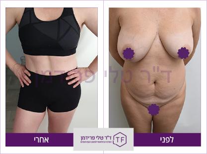 עיצוב פלג גוף עליון והרמת חזה לפניו אחרי - ד"ר טלי פרידמן