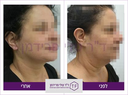 מתיחת פנים וצוואר לפני ואחרי - ד"ר טלי פרידמן