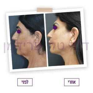 מיצוק עור הפנים לפני ואחרי - ד"ר טלי פרידמן