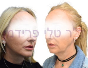 מתיחת פנים וצוואר