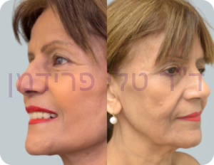 ניתוח פנים לפני ואחרי