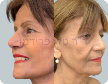 ניתוח פנים לפני ואחרי